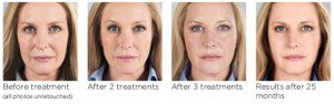 Sculptra before and after