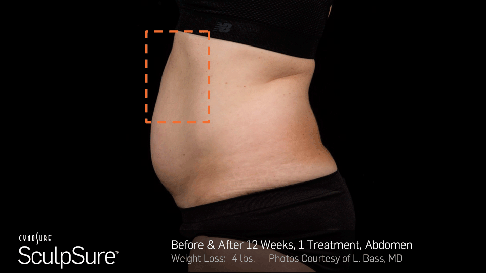 BA-SculpSure-LBass-12Wks-1Tx-05