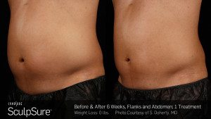 Sculpsure before and after