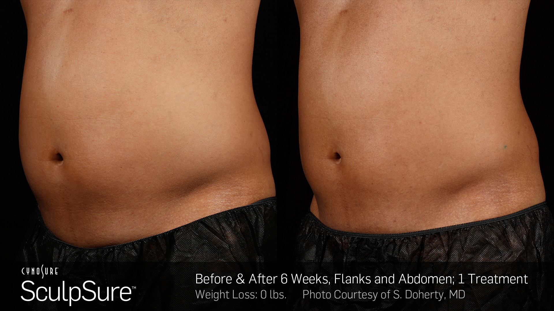 BA-SculpSure-S-Doherty-Post1Tx-6weeks-04