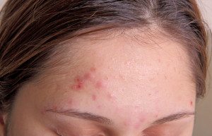 acne vulgaris