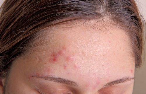 acne vulgaris