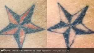 tattoo removal carlsbad
