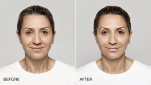 Before and after facial treatment