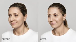 Before and after facial treatment