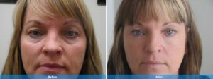 Dermal Filler before and after