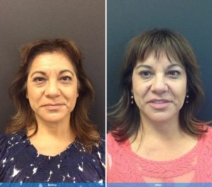Dermal Filler before and after