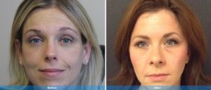 Acne treatment before and after