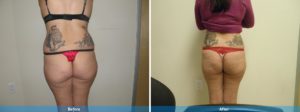 body contouring before and after