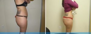 body contouring before and after