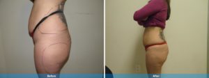 body contouring before and after