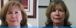 Dermal fillers before and after