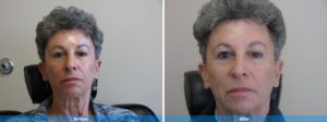 Dermal fillers before and after