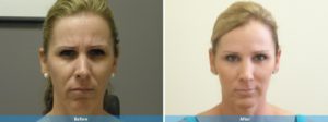 Dermal fillers before and after