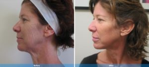 Fraxel before and after