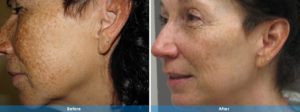IPL before and after