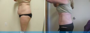 LaserLipo before and after
