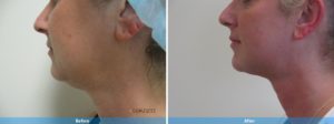 LaserLipo before and after