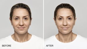 facial treatment before and after