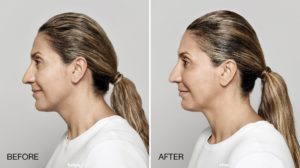 facial treatment before and after