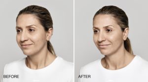 facial treatment before and after