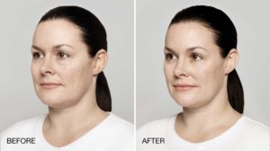facial treatment before and after