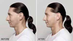 facial treatment before and after