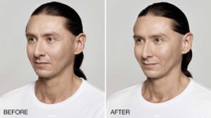 facial treatment before and after