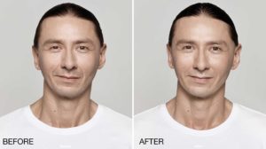 facial treatment before and after