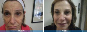 facial treatment before and after