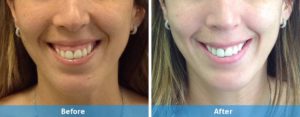 Botox for gummy smile before and after