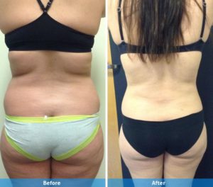 LaserLipo before and after