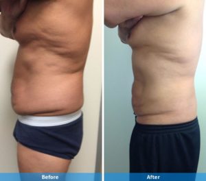 LaserLipo before and after