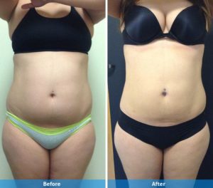 LaserLipo before and after