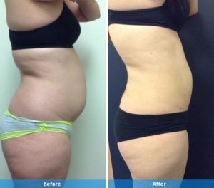 LaserLipo before and after