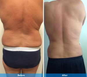 LaserLipo before and after