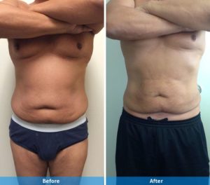 LaserLipo before and after
