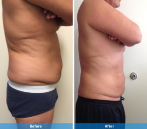 LaserLipo before and after