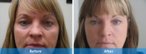 dermal fillers before and after