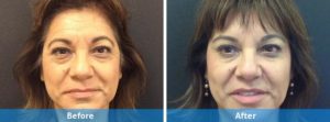 Juvederm before and after