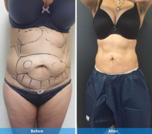 Before and after LaserLipo