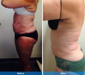 Before and after LaserLipo
