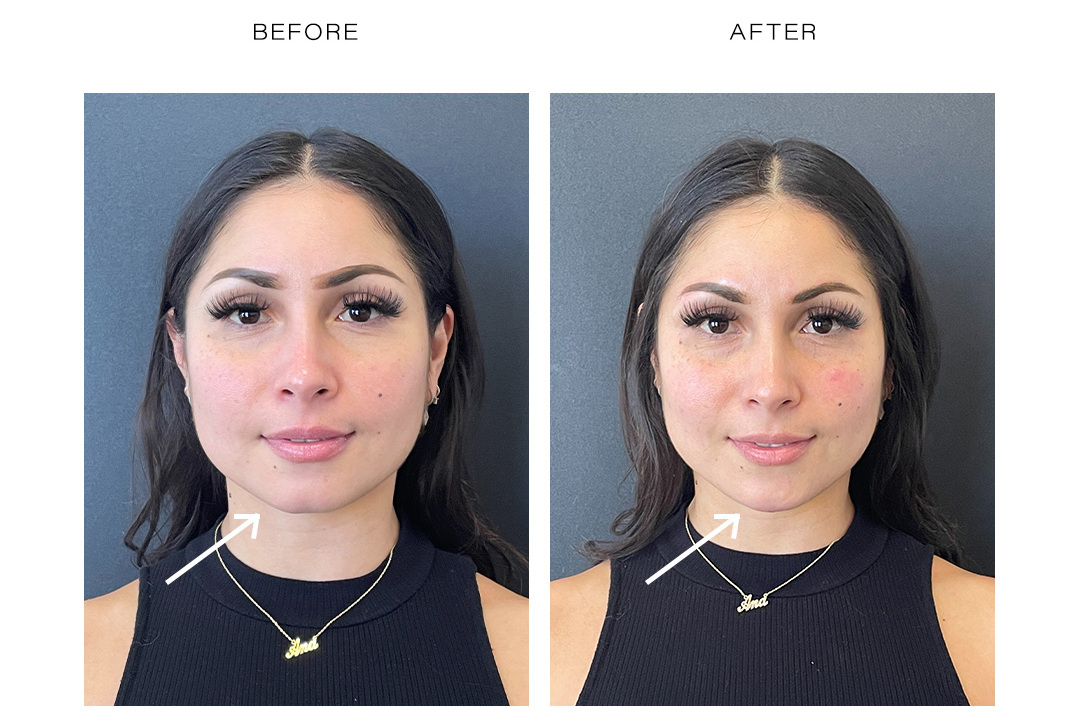 juvederm patient