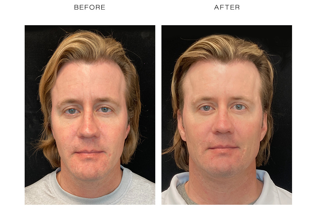 botox before after