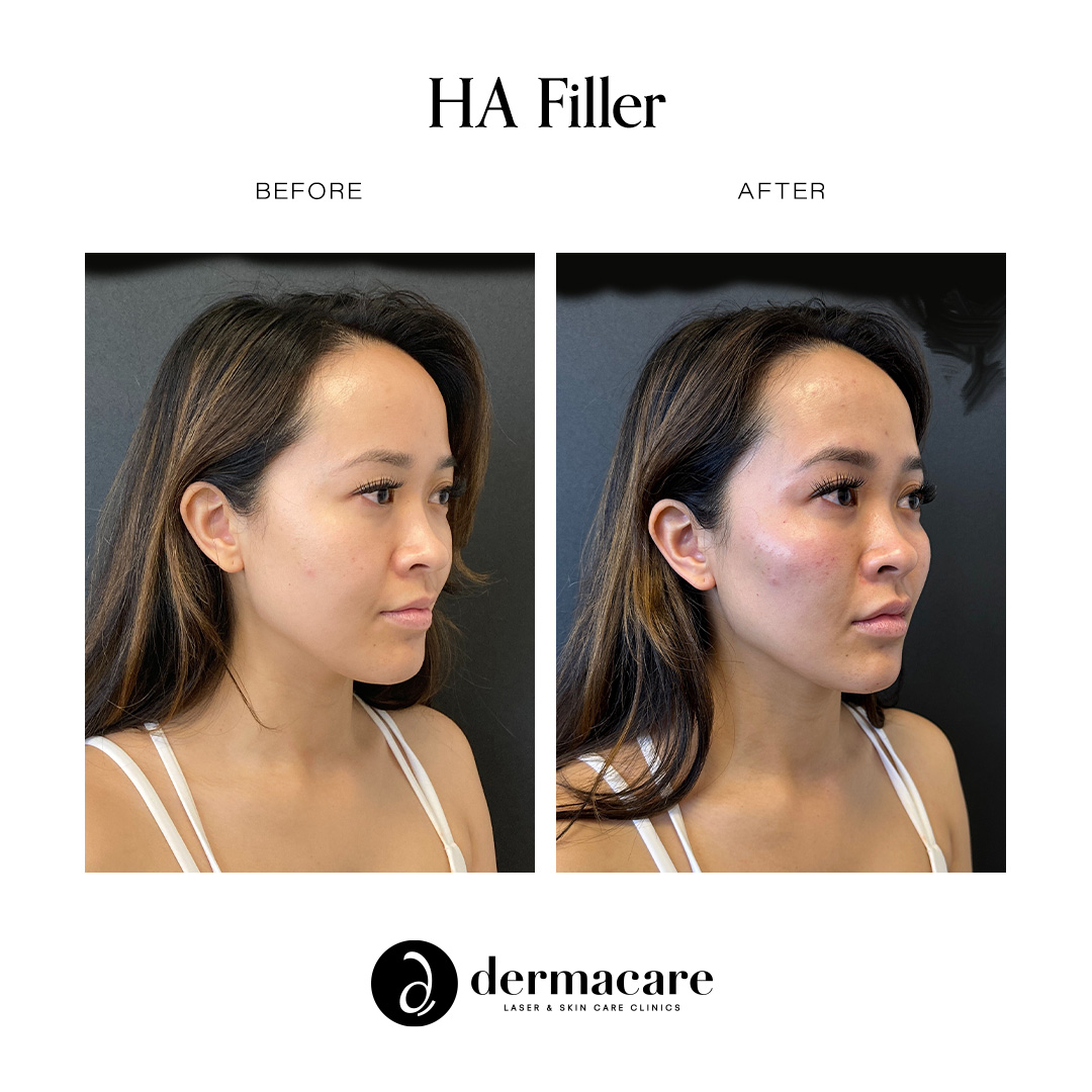 Restylane patient