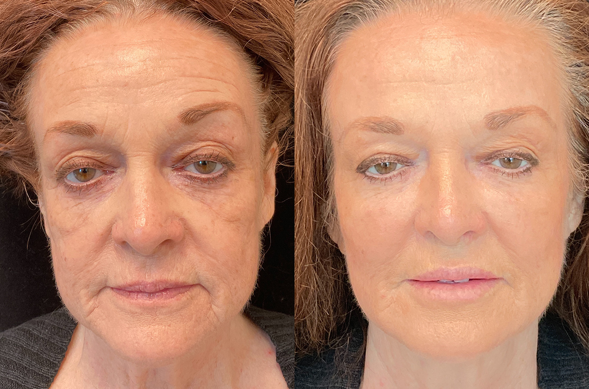 botox before after woman