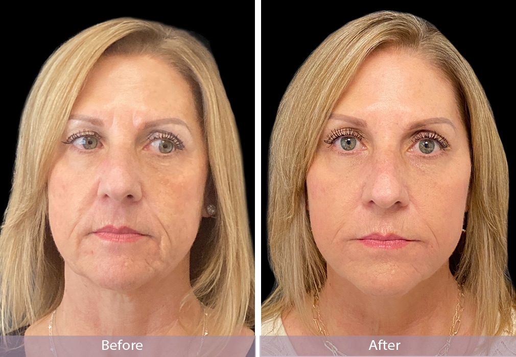 dermal filler botox patient