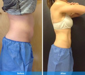 CoolSculpting Before &amp; After San Diego