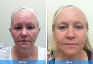 CO2 Laser Resurfacing before and after