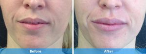 juvederm before and after
